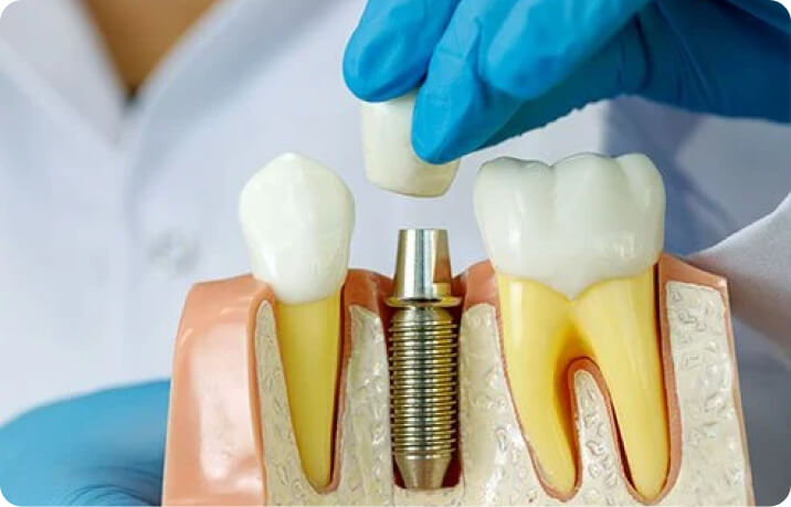 Conoce a nuestros aliados: MDI Implantes